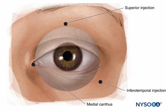 Regional Anesthesia