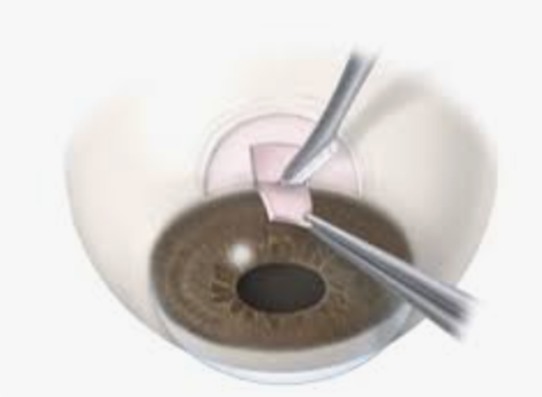 Treatment of glaucoma