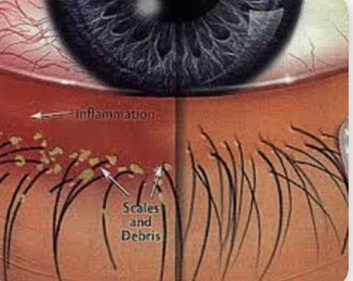Blepharitis