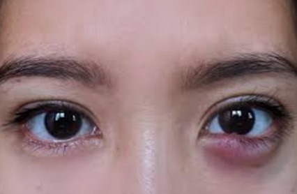 External Eye Disorders