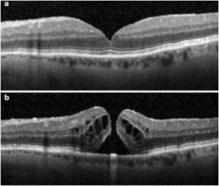 Macular Hole