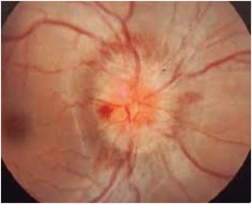 Optic Neuritis