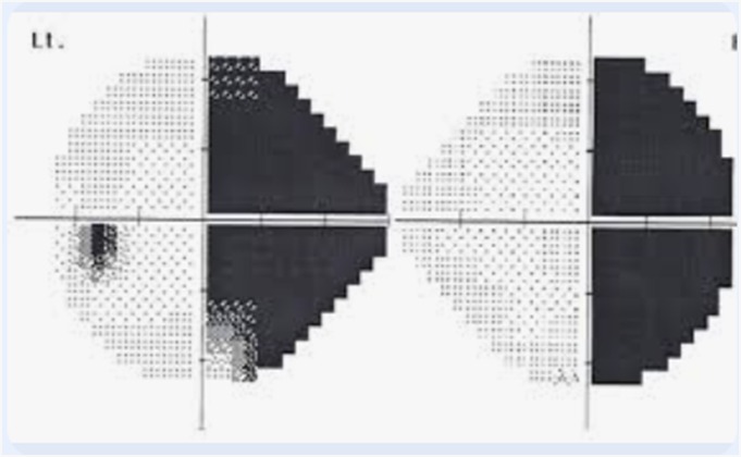 Perimetry in Stroke