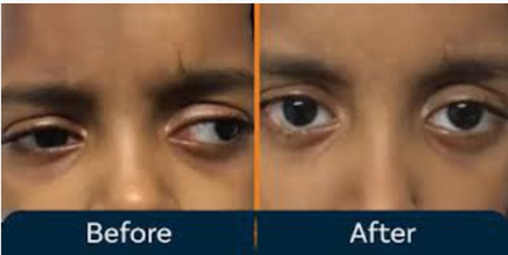 Squint Treatment